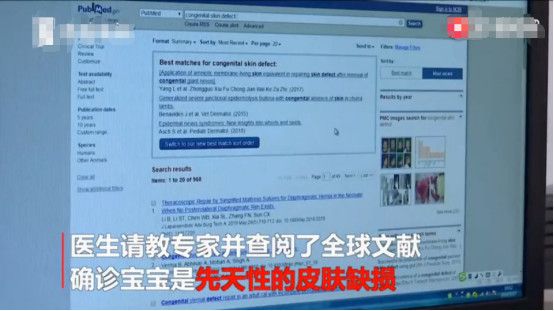                     新生儿被发现患有罕见病，天生头皮少一块，发生率仅为千万分之一