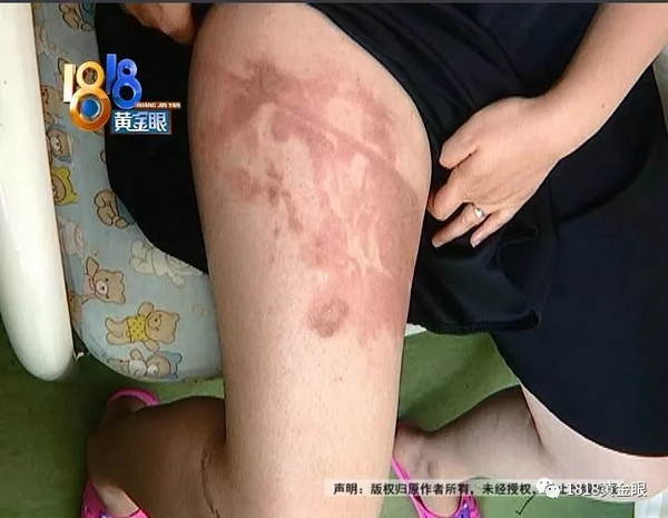                     一家人去下馆子，宝宝被水烫了，多处二度烫伤
