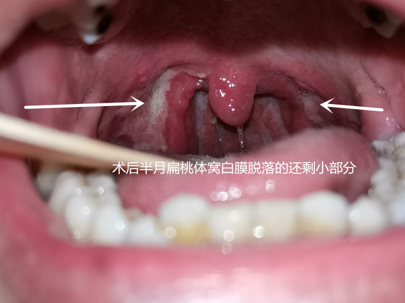 这时扁桃体窝白膜开始脱落,这个时候,如果你饮食不注意,或者感染,就有