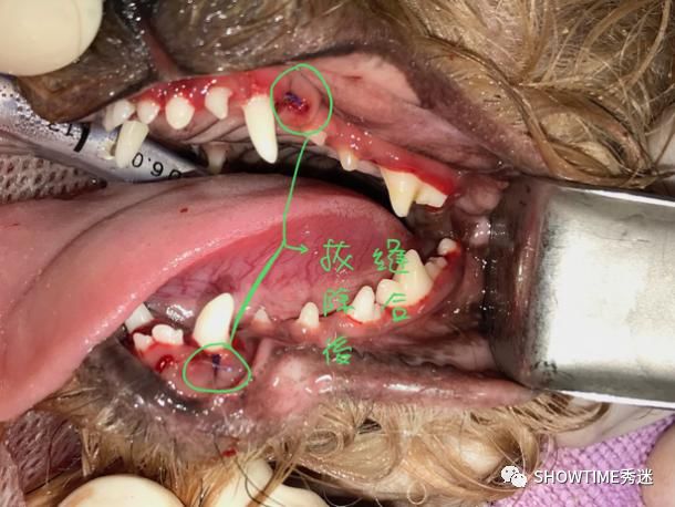 常见莫名连续打喷嚏诊断:乳齿存留导致严重牙周病,并形成口鼻瘘管治疗