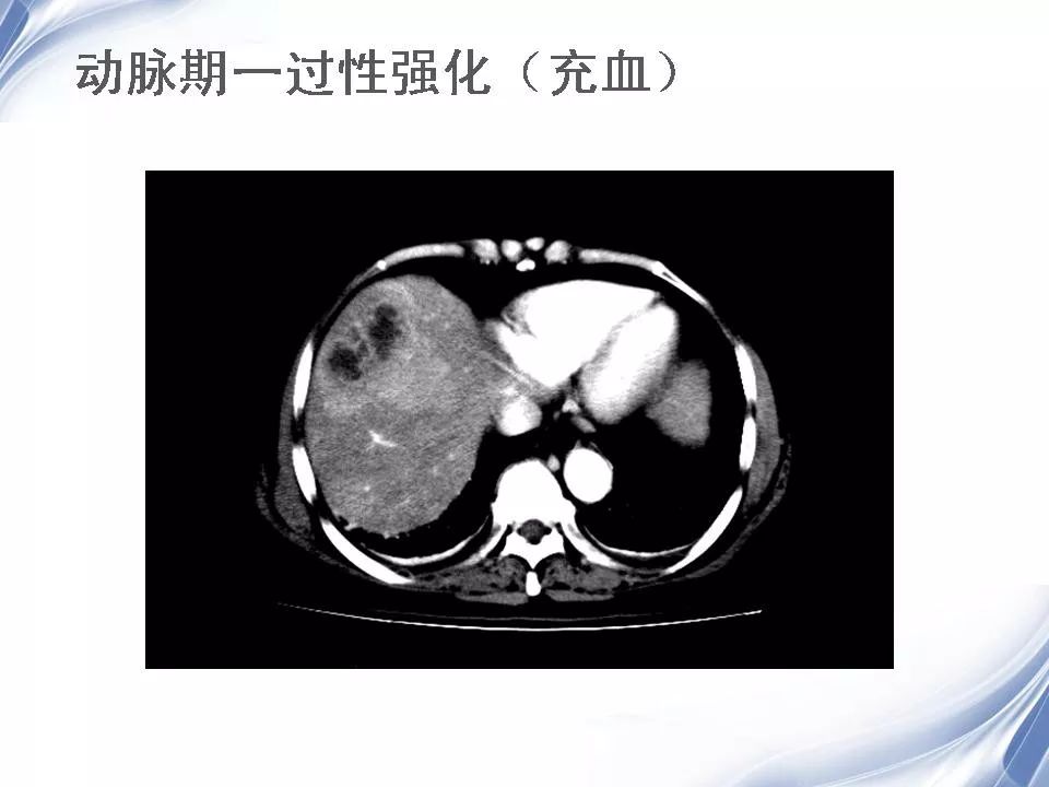 细菌性肝脓肿的影像诊断 | 影像天地