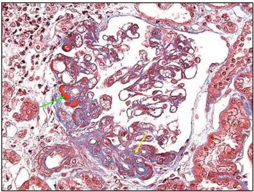 肾内病理图解局灶节段性肾小球硬化