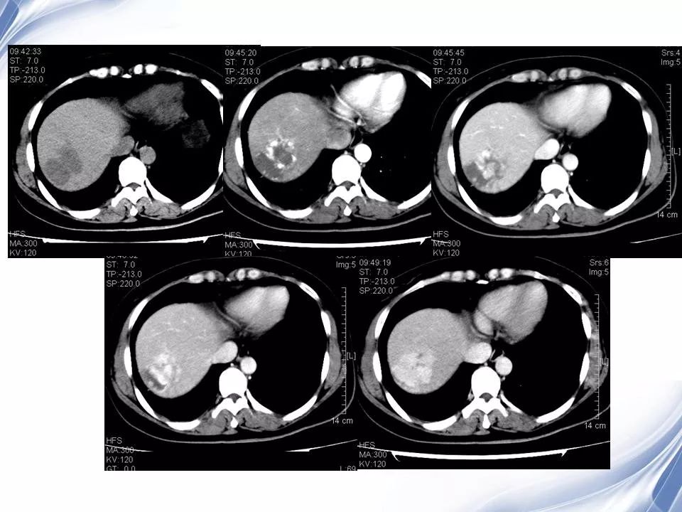 细菌性肝脓肿的影像诊断影像天地