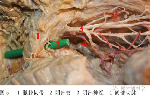 压 ③阴部神经在进入坐骨小孔处 ④阴部神经跨越骶结节韧带的镰状缘时