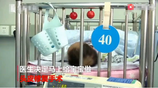                     新生儿被发现患有罕见病，天生头皮少一块，发生率仅为千万分之一