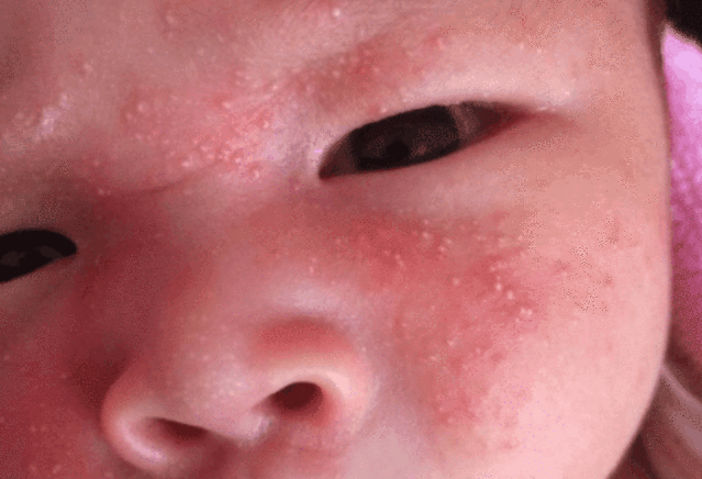                    夏天宝宝得渗出性“湿性湿疹”, 宝妈万分焦虑, 1招根除湿疹