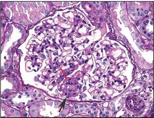 肾内病理图解 | 局灶节段性肾小球硬化