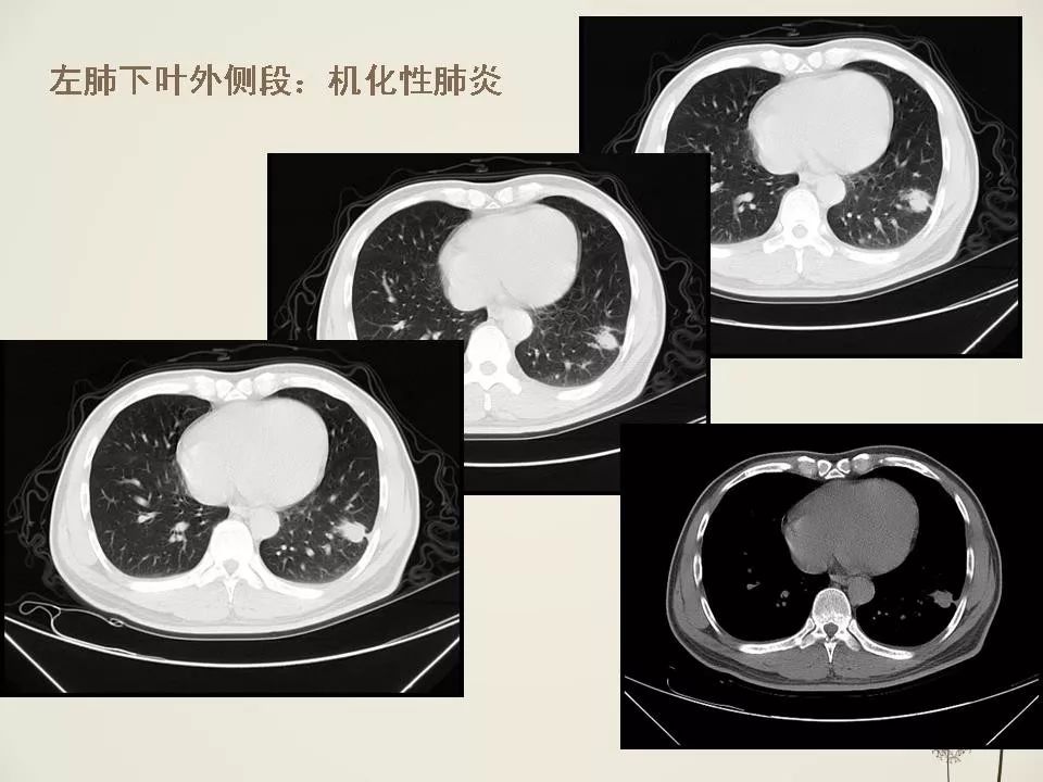 少见良性肺结节ct表现影像天地