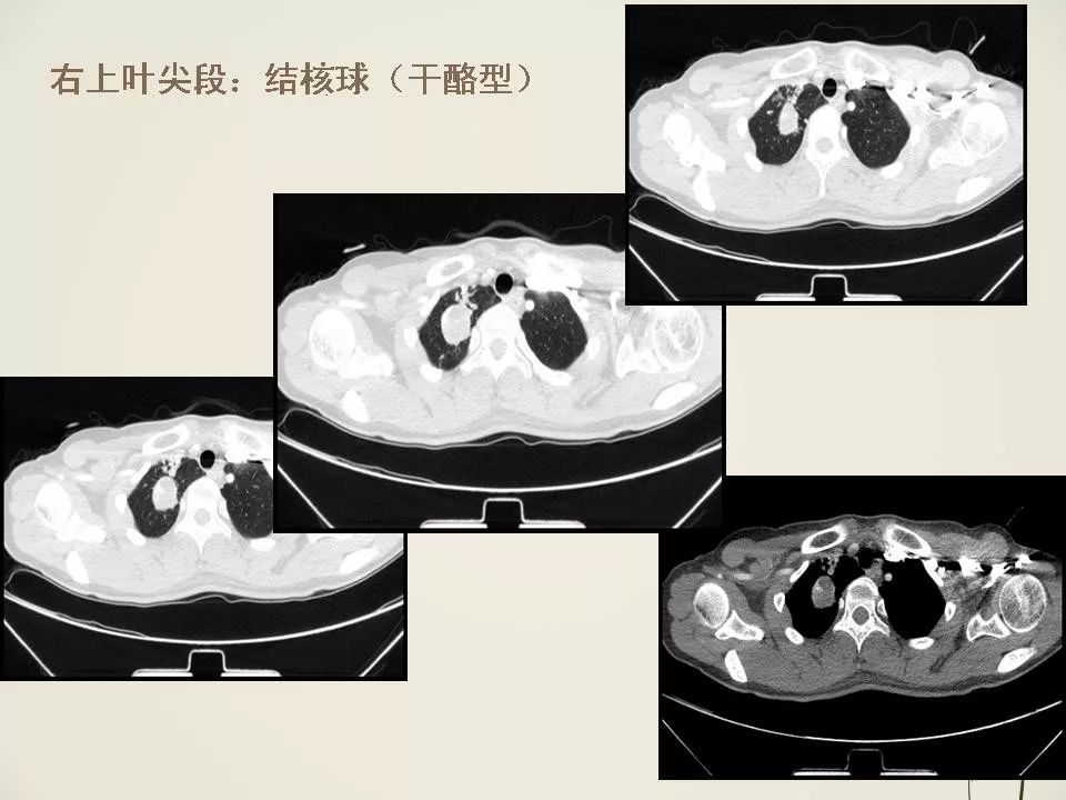 少见良性肺结节ct表现影像天地