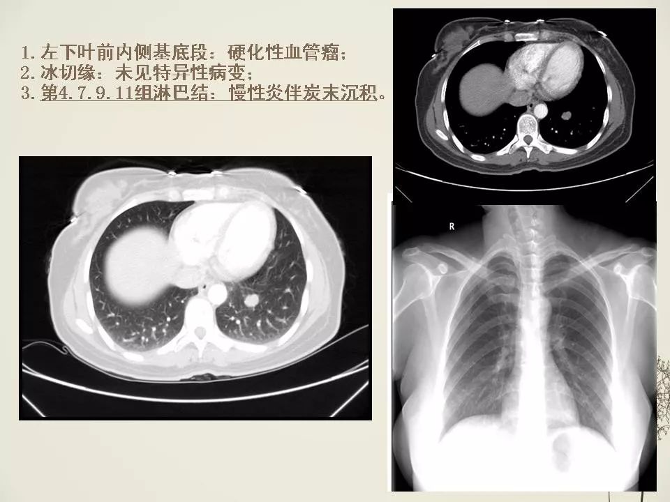 少见良性肺结节ct表现 | 影像天地
