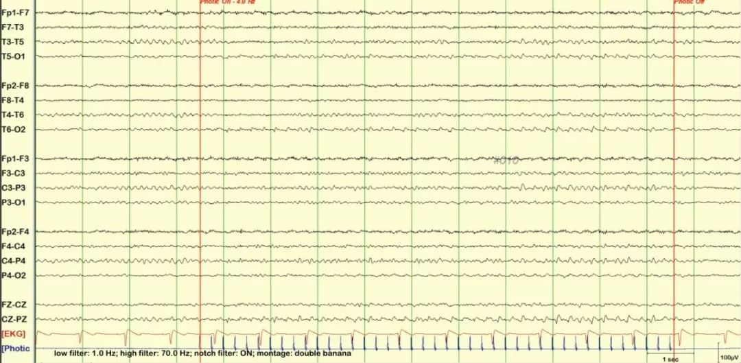 未标注脑电图(双极导联-双香蕉)