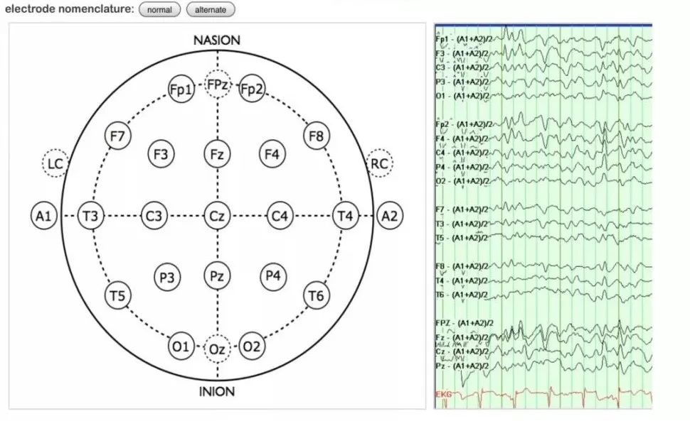 正常篇:最一目了然的成人脑电图图谱|一键收藏