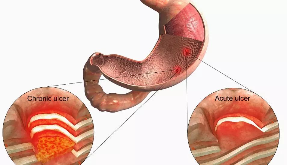 胃糜烂和胃溃疡哪种更严重东大专家为你解说