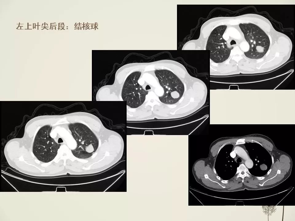 少见良性肺结节ct表现影像天地