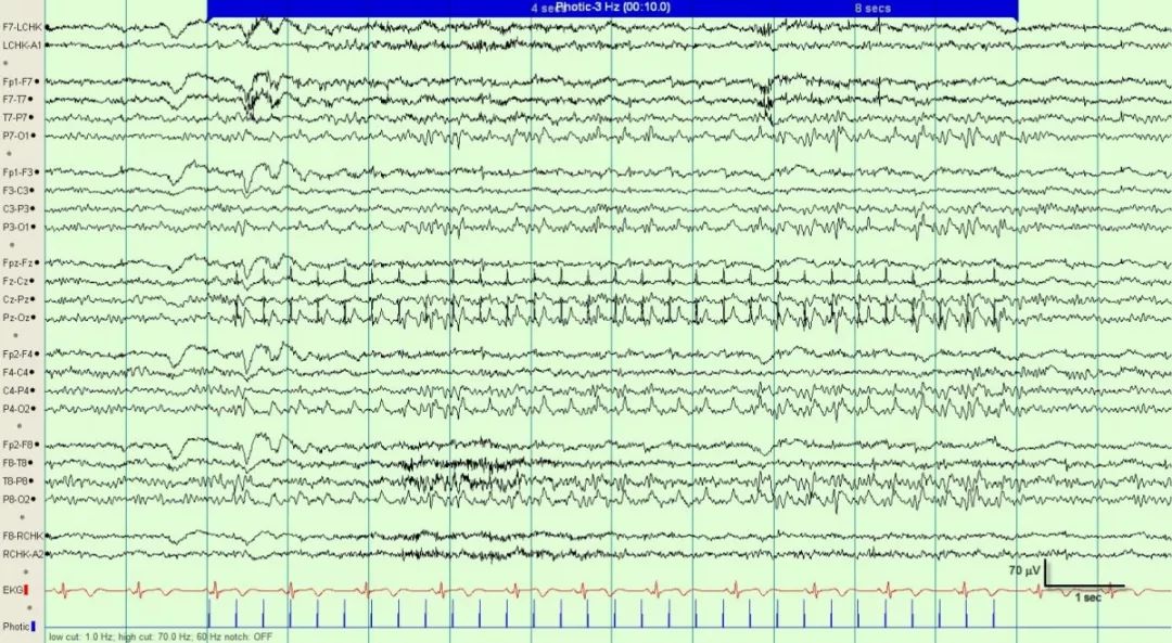 正常篇:最一目了然的成人脑电图图谱|一键收藏