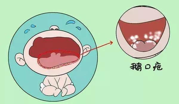                     原创            宝宝口腔里白白的是有问题吗？儿科医生说应该是这个疾病