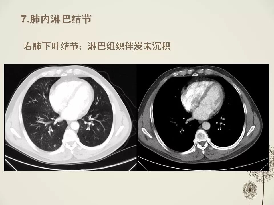 少见良性肺结节ct表现影像天地