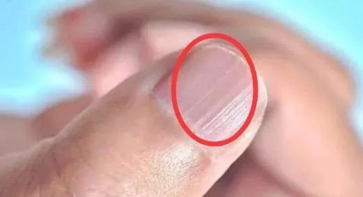 所以说我们的指甲表面就会出现凹凸不平,且部分患者还会出现黑色竖纹
