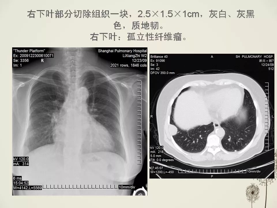 少见良性肺结节ct表现 影像天地 6598