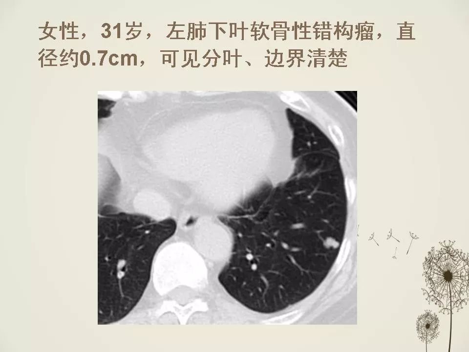 少见良性肺结节ct表现 | 影像天地