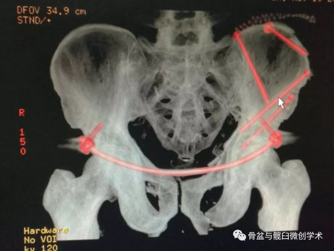 专家投稿涉及四边体的c型骨盆骨折微创治疗