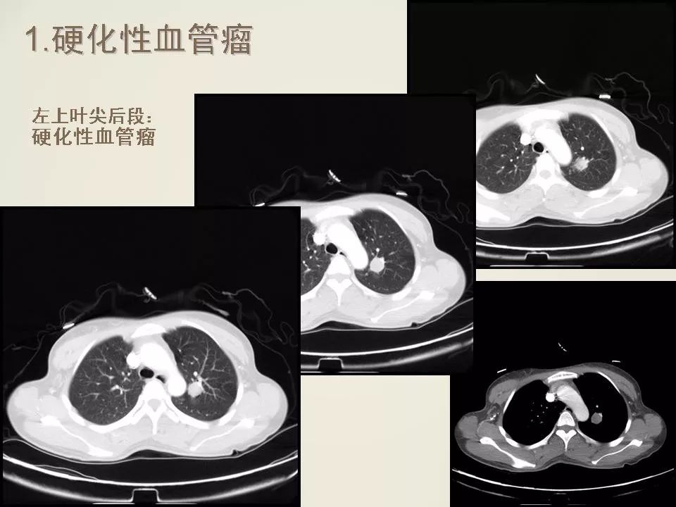 少见良性肺结节ct表现影像天地