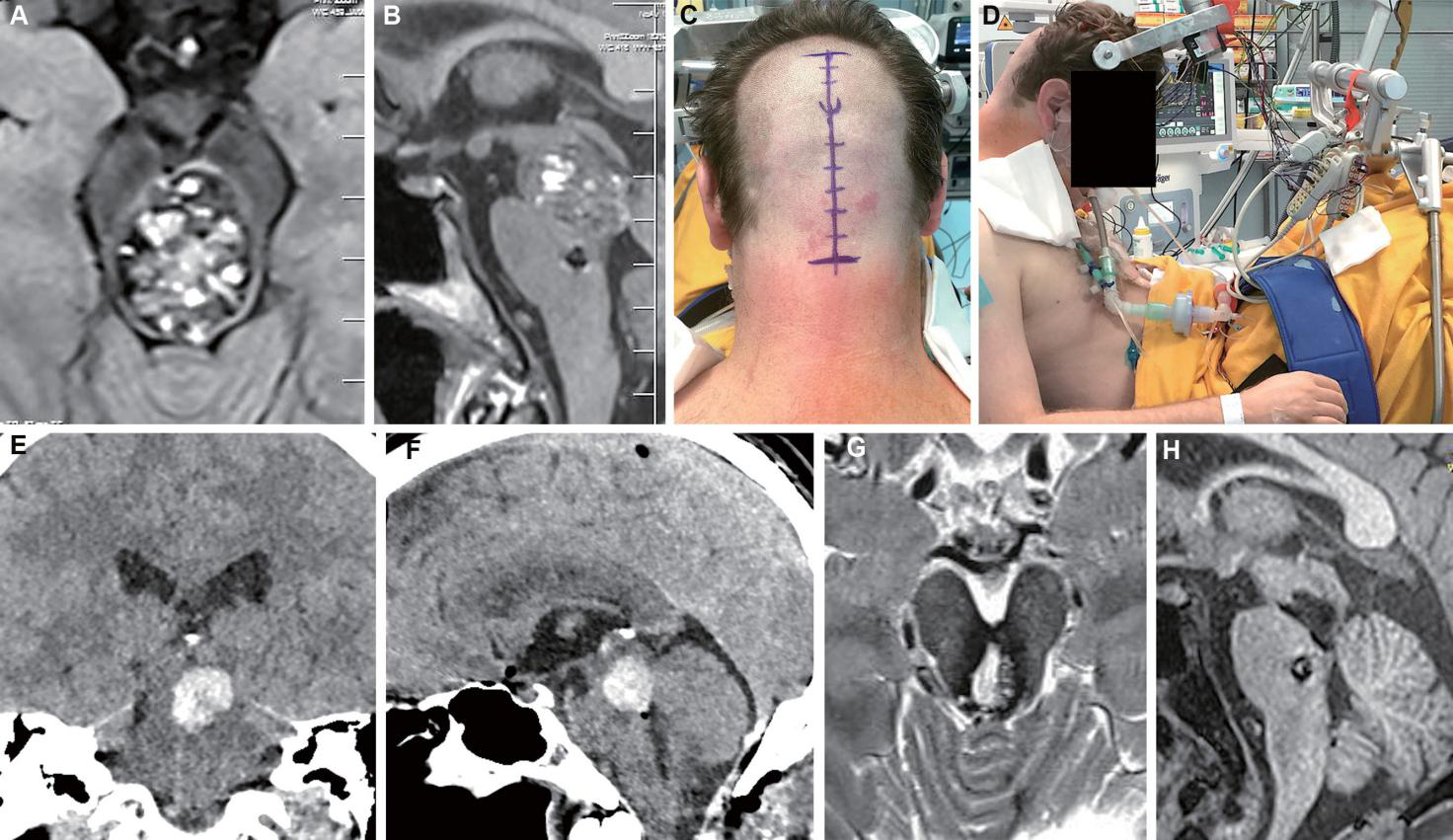一位40岁脑海绵状血管瘤晚期患者的全切手术过程