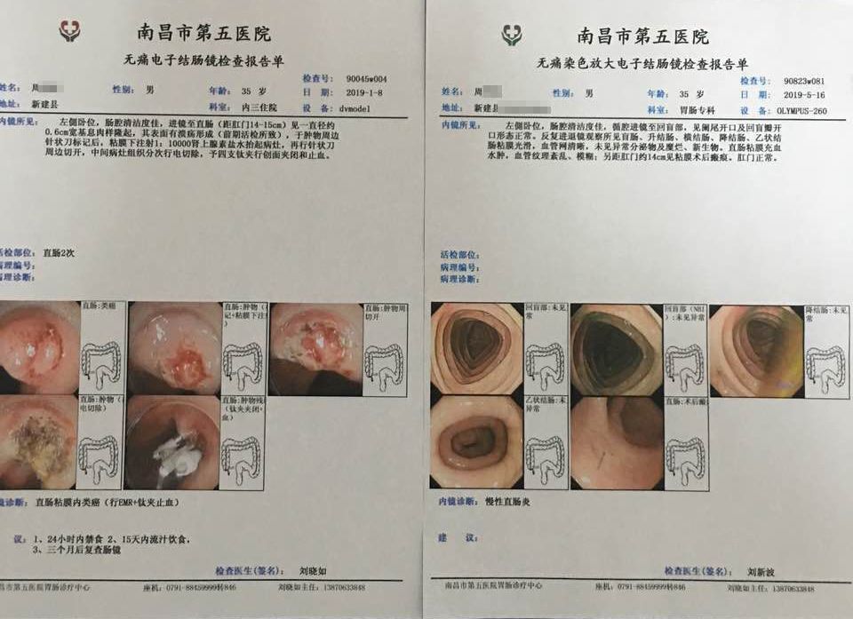 6cm宽基息肉样隆起,取组织活检后病理检查确诊为早期直肠类癌.