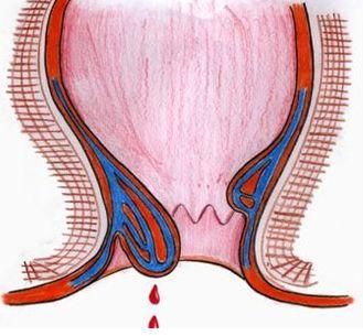 怎么判断自己得痔疮了?