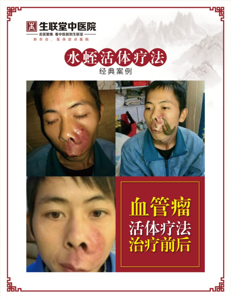 【水蛭的活体疗法药理】 水蛭在吸血的过程中会分泌大量唾液,水蛭的