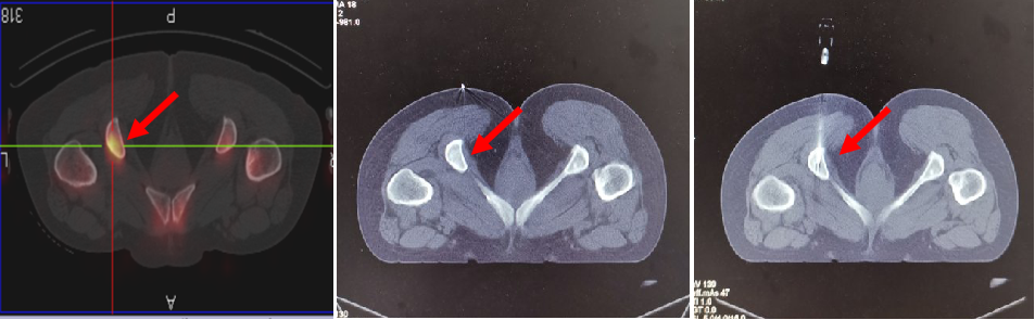 CT�����µĹǴ��̻�� (ԭ��)