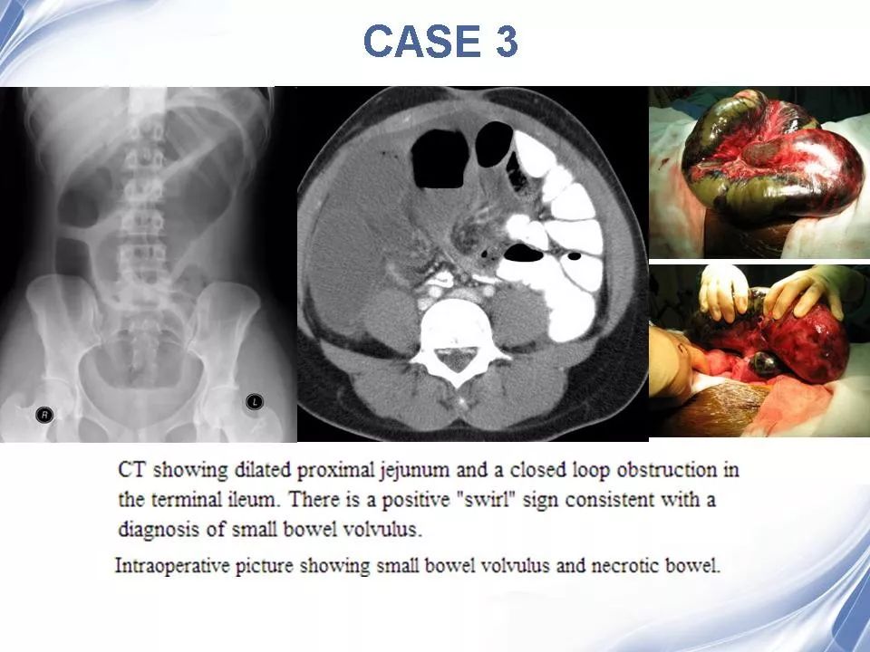 小肠扭转ct诊断 | 影像天地