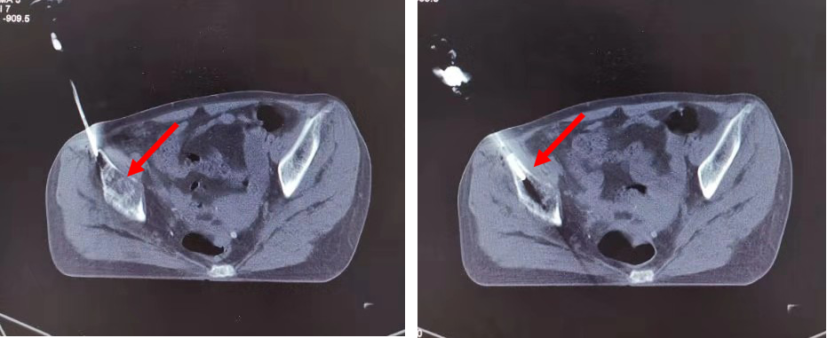 CT�����µĹǴ��̻�� (ԭ��)