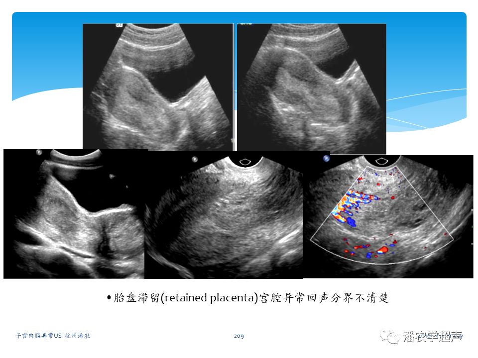 子宫内膜癌的超声诊断