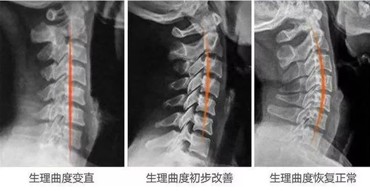 让颈部在睡觉的时候就能恢复正常的生理曲线