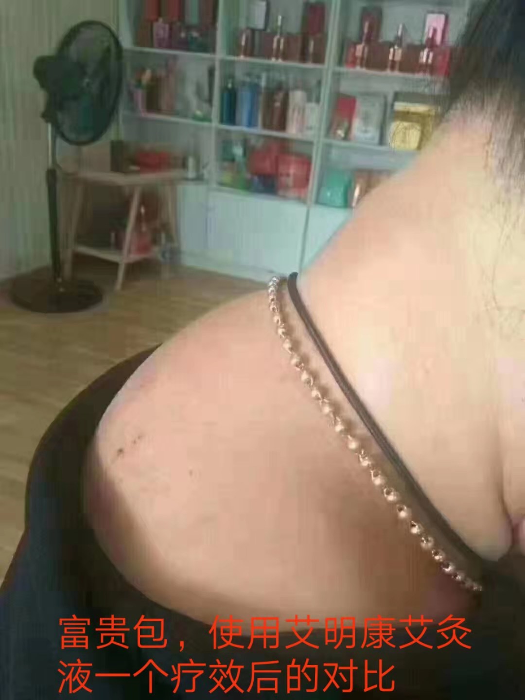 什么办法可以消除富贵包 7dada7fa93bf4346b7ca37c2f420d079.jpeg