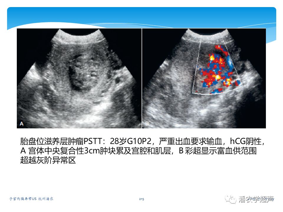 子宫内膜癌的超声诊断