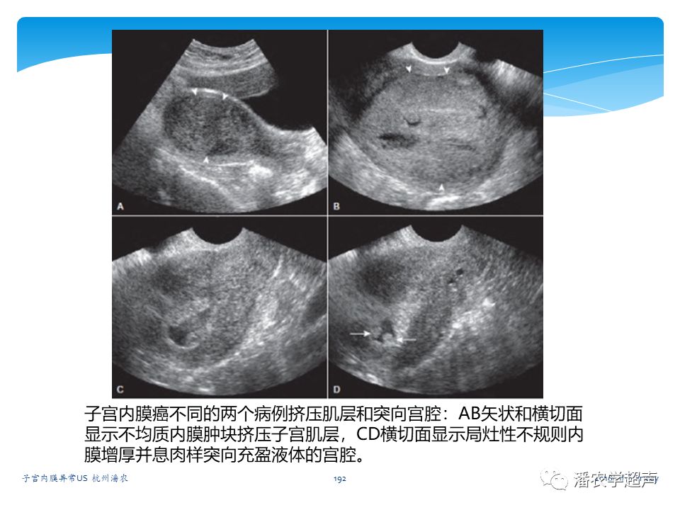 子宫内膜癌的超声诊断