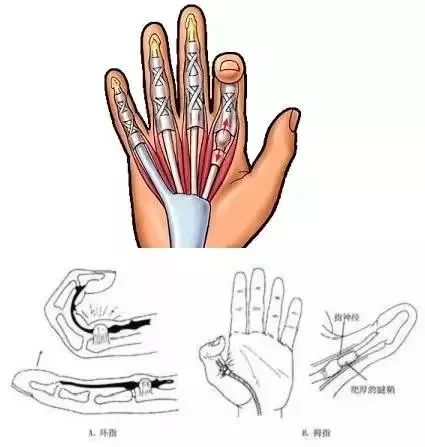 手指屈肌腱腱鞘炎多发生于拇指,食指与中指的手掌面,清晨醒来时特别