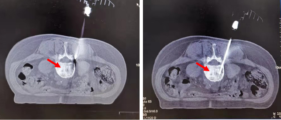 CT�����µĹǴ��̻�� (ԭ��)