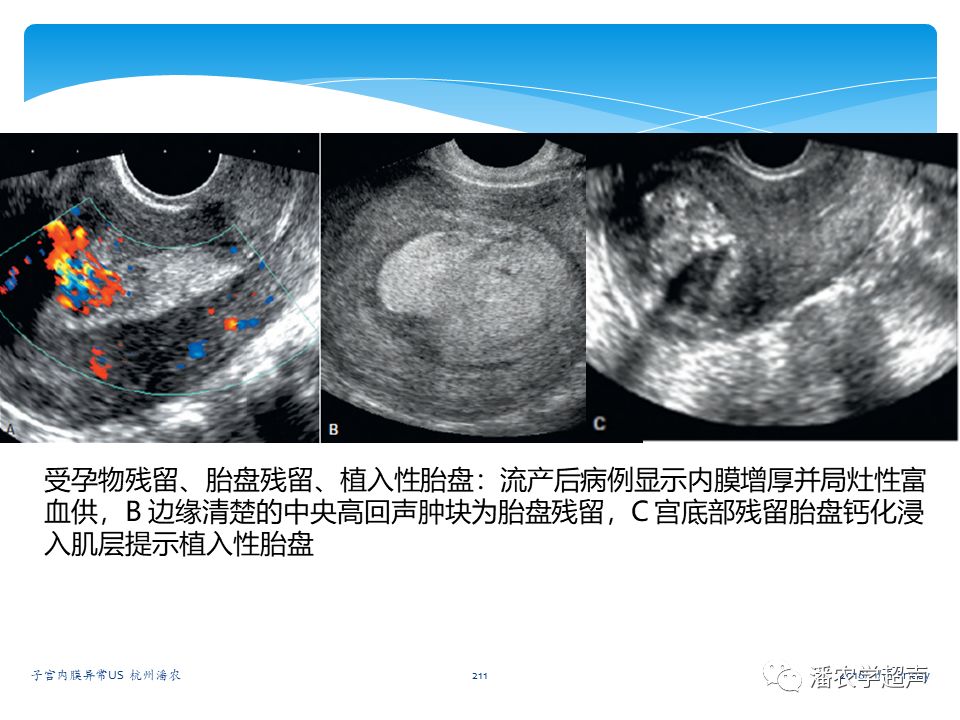 子宫内膜癌的超声诊断