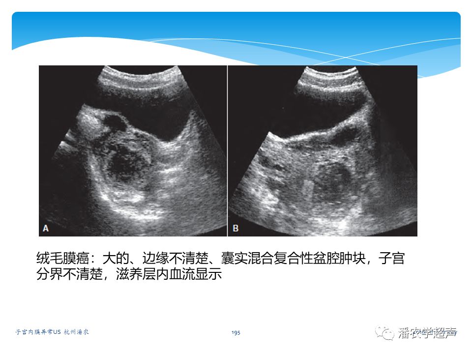 子宫内膜癌的超声诊断