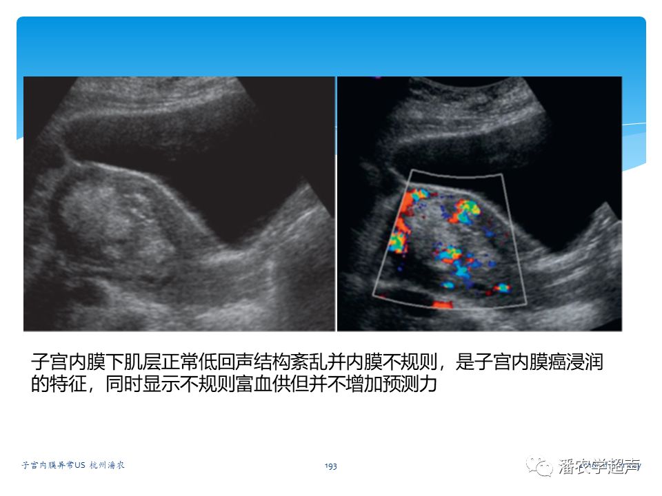 子宫内膜癌的超声诊断