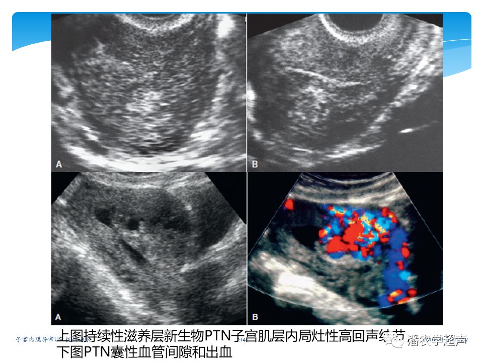 子宫内膜癌的超声诊断