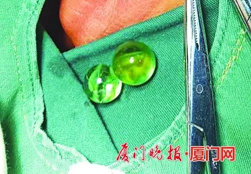                     厦门5岁男孩把两颗玻璃珠塞进下体，还和姐姐一起瞒着父母！结果……