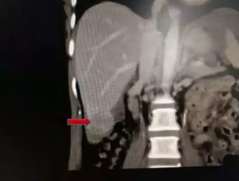                     妈妈突然腹部剧痛，一查竟然“爆肝”了？！医生：不能这样宠娃！
