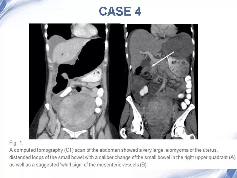 小肠扭转ct诊断 | 影像天地