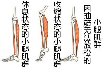 什么原因导致肌肉痉挛 0156685ed0854fbc9d6b4ebd31d75992.jpeg