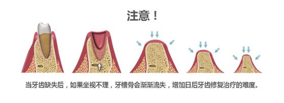 种植牙你不知道的事牙槽骨骨量太少能做种植牙吗