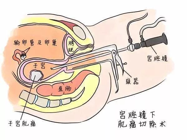 得了妇科病你会选择做妇科腹腔镜手术吗